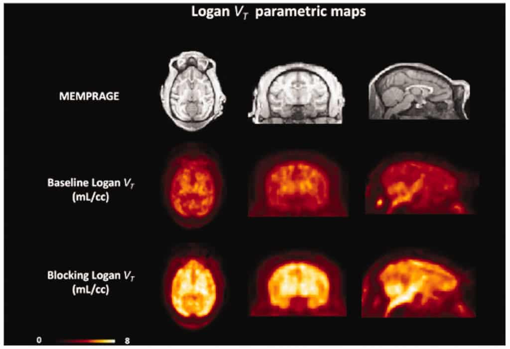 Structural MRI (MEMPRAGE) and [11C]mG2P001 Logan VT images for the baseline (middle) and blocking conditions (lower)