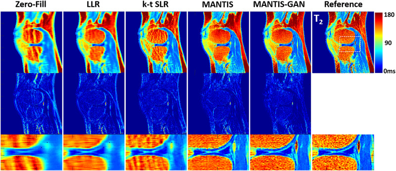 Fig. 6. Comparison of T2 maps reconstructed from MANTIS-GAN and MANTIS with maps from joint x-p reconstruction methods at an acceleration rate R = 8 in one real sagittal knee slice. 